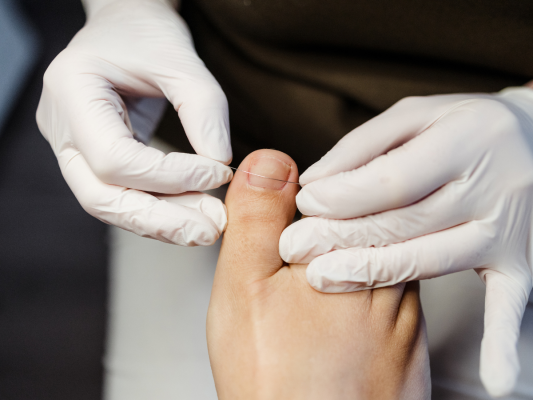 voetenspecialist-miranda-unibrace-nagelbeugel